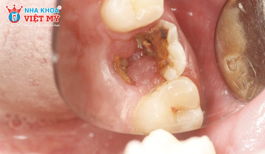 Nguyên nhân khiến răng hàm bị vỡ