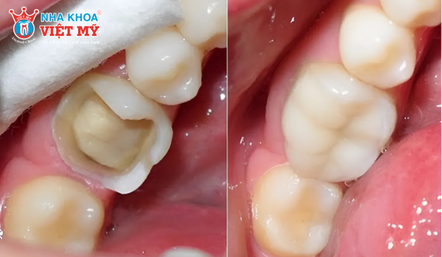 Các phương pháp phục hình răng hàm bị vỡ