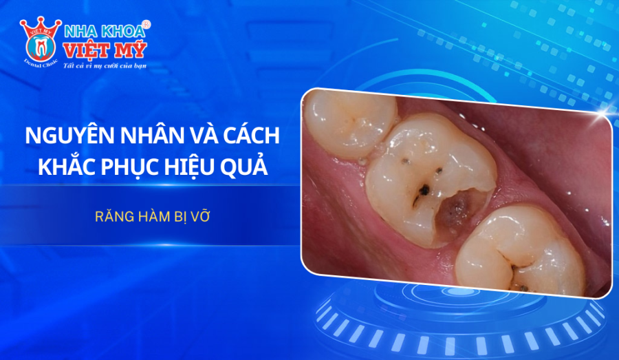 Nguyên nhân và cách khắc phục hiệu quả khi răng hàm bị vỡ