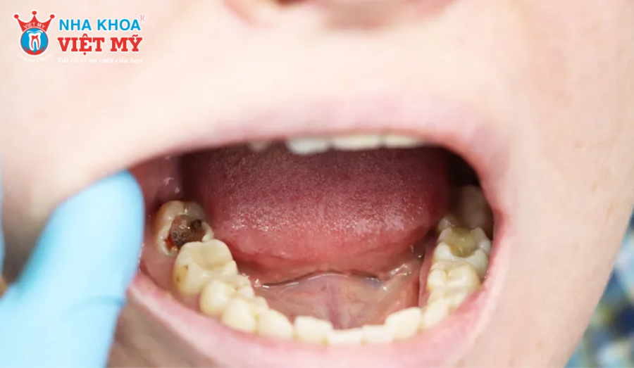 Răng hàm bị vỡ có ảnh hưởng gì không?