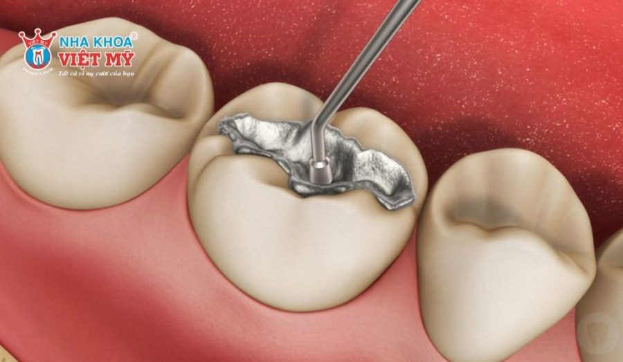 Trám răng bằng vật liệu Amalgam dễ gây ngộ độc