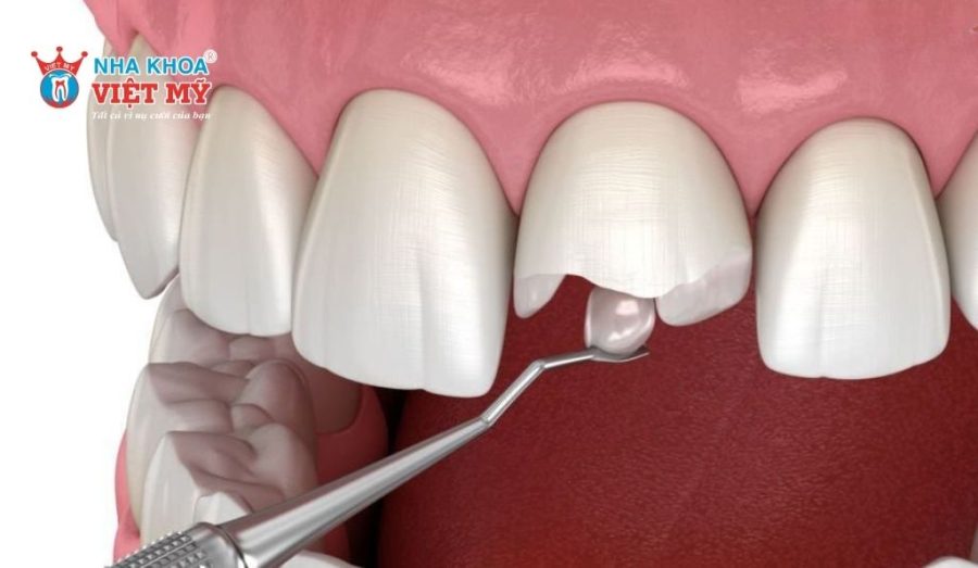 Trám răng giúp khắc phục tình trạng răng mẻ, thưa, tổn thương nhẹ