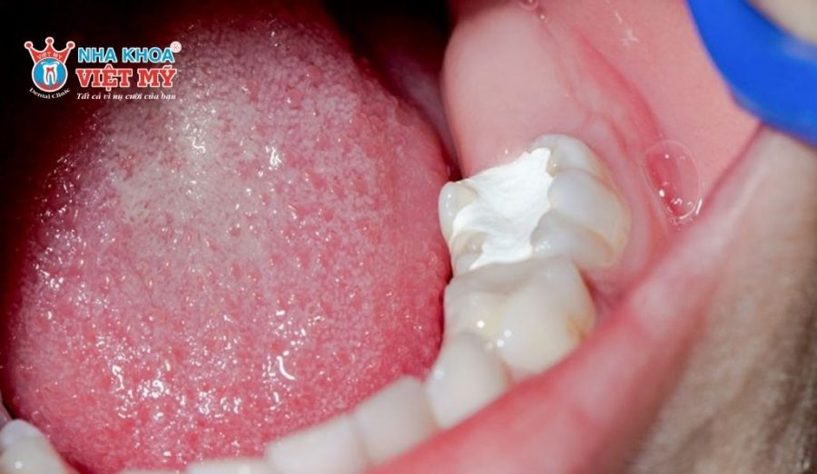 Có nên tự trám răng tại nhà?