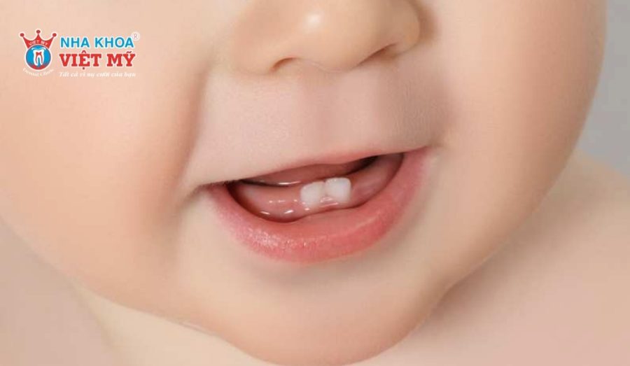 Răng sữa thường bắt đầu nhú lên từ khoảng 6 tháng tuổi