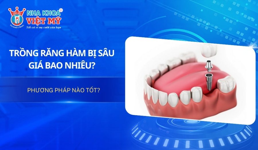 Trồng răng hàm bị sâu giá bao nhiêu? Phương pháp nào tốt?