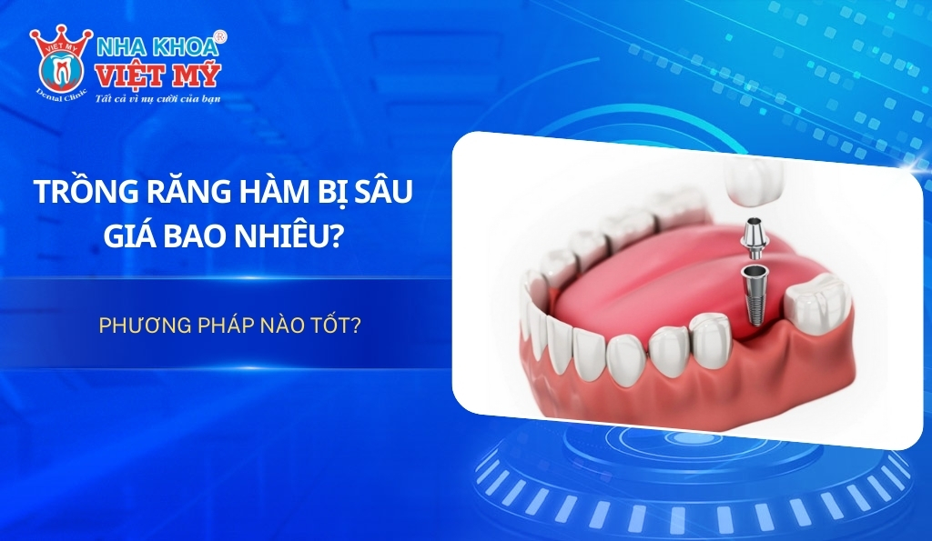 Trồng răng hàm bị sâu giá bao nhiêu? Phương pháp nào tốt?