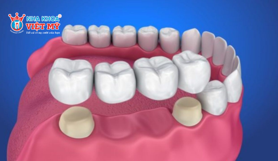 Bắc cầu răng sứ vừa thẩm mỹ vừa có chi phí hợp lý