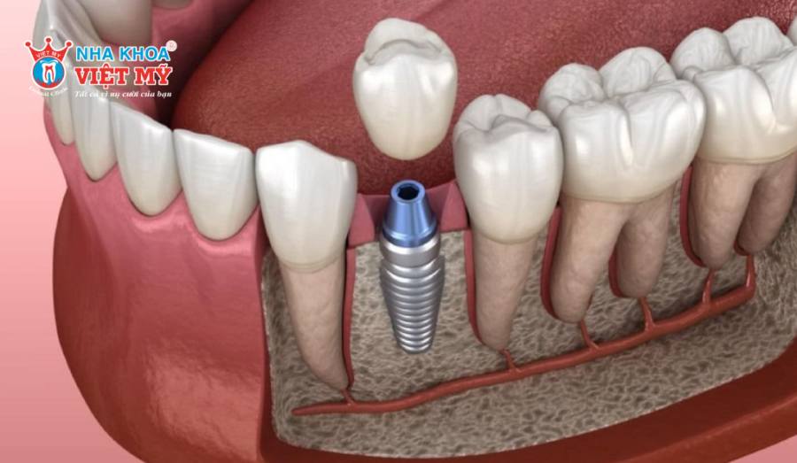 Trồng răng hàm bằng phương pháp cấy ghép Implant