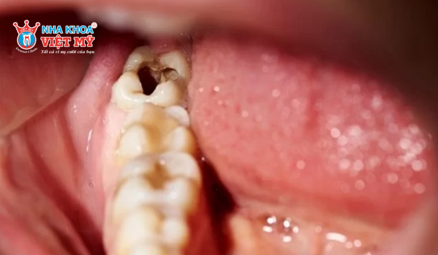 Răng hàm sâu nặng thì cần nhổ và trồng răng giả