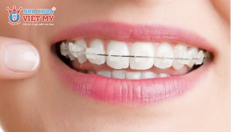 40 tuổi có niềng được không?