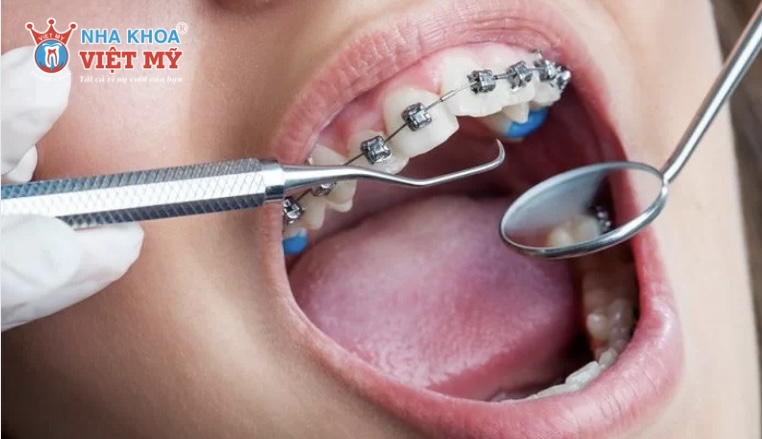 Chi phí niềng răng tuổi 40 là bao nhiêu?