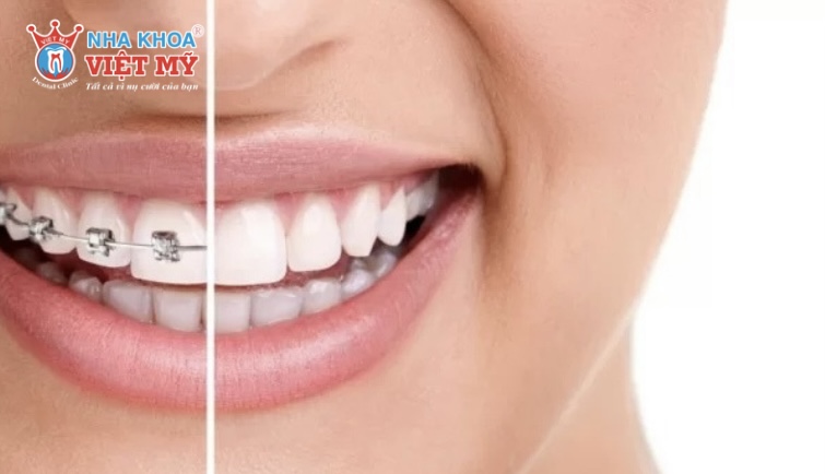 Niềng răng tuổi 40 mất bao lâu?