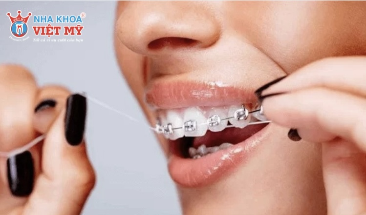 Các lưu ý quan trọng khi niềng răng ở tuổi 40