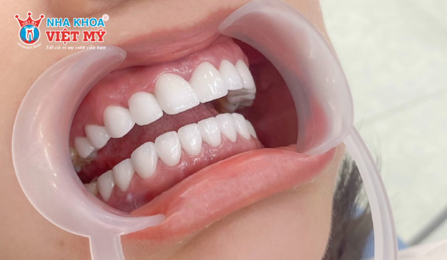 Bọc răng sứ nguyên hàm giúp cải thiện toàn diện nụ cười và sức khỏe răng miệng