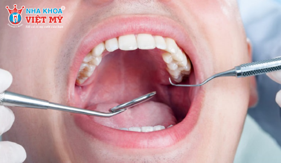 Cost of Additional Procedures: Factors like Bone Grafting or a Sinus Lift may be necessary.