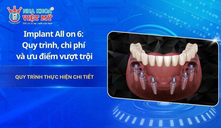 Implant All On 6: Quy trình, chi phí và ưu điểm vượt trội
