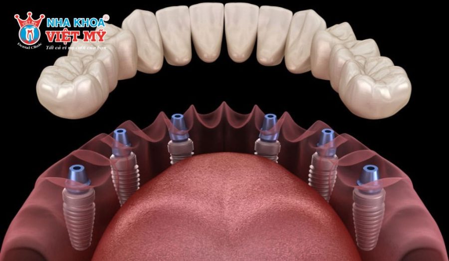 Implant All On 6 sử dụng 6 trụ Implant titanium cấy trực tiếp vào xương hàm