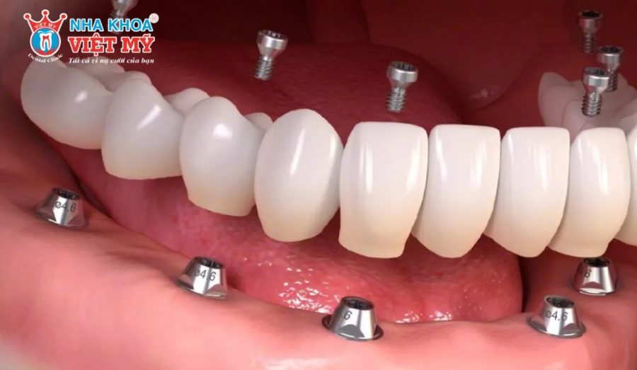 Phương pháp Implant All On 6 có tính thẩm mỹ cao, đẹp tự nhiên