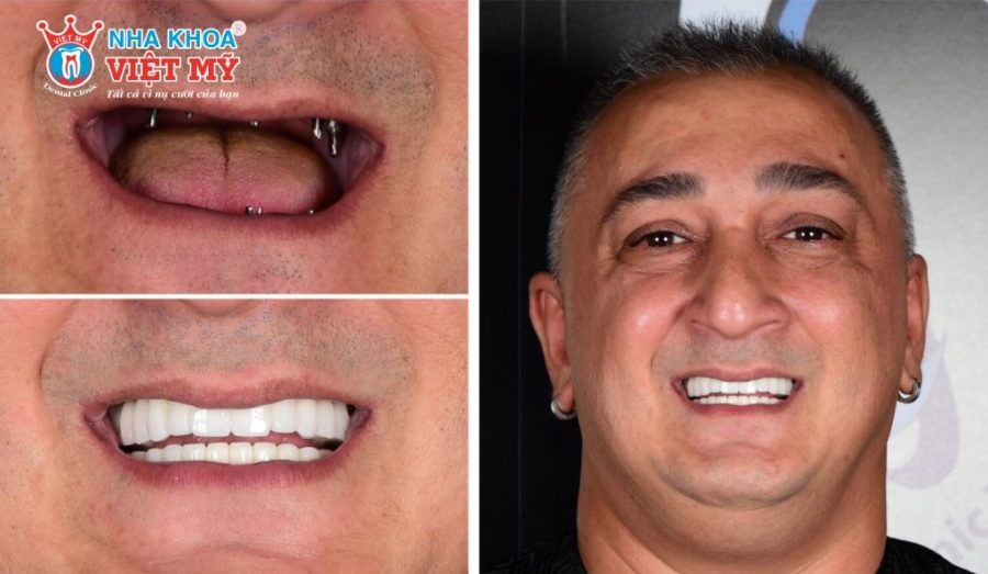 Người bị tiêu xương hàm nghiêm trọng do viêm nha chu thích hợp với Implant All On 6