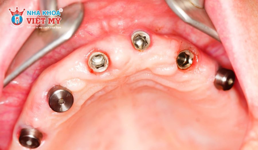 Implant All On 6 yêu cầu xương hàm phải đạt đủ độ dày và mật độ chắc khỏe