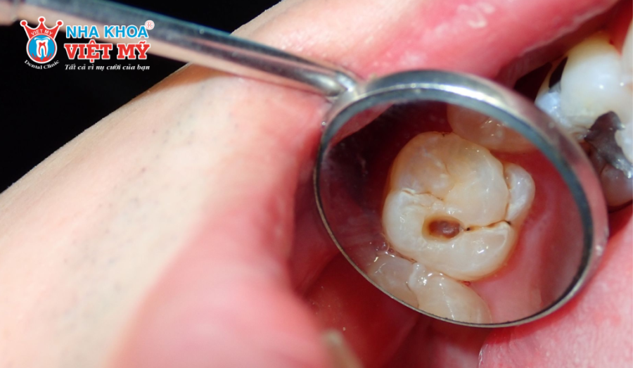 Răng sâu, sứt mẻ hay hư tổn nên bọc sứ để bảo vệ răng và tăng bền chắc