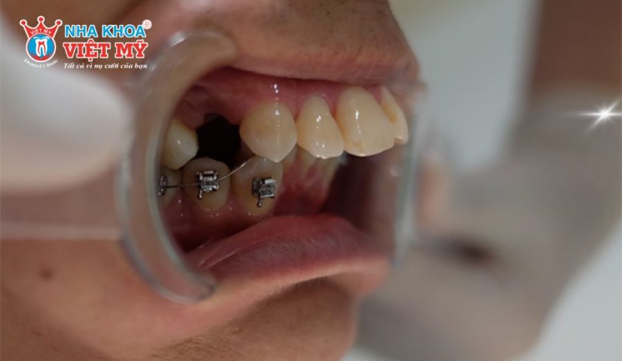 Răng hô, móm, lệch lạc cần nhổ răng trước khi niềng