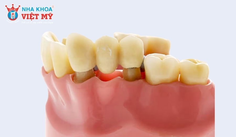 Bắc cầu răng sứ có bền không còn phụ thuộc vào nhiều yếu tố