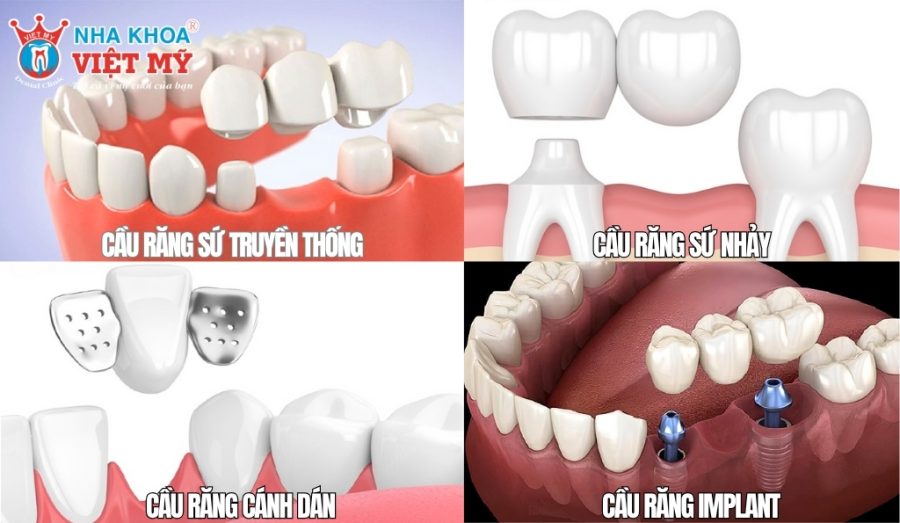 Tùy vào tình trạng răng miệng nên chọn loại cầu răng sứ phù hợp
