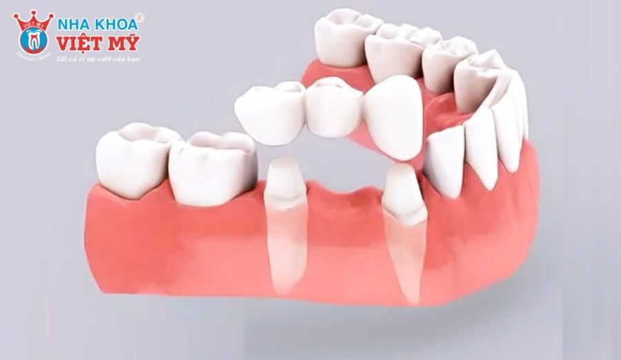 Giải pháp bắc cầu răng sứ có bền không?