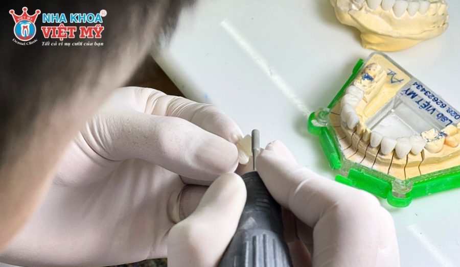 Quy trình làm cầu răng sứ chuyên nghiệp tại Nha Khoa Việt Mỹ