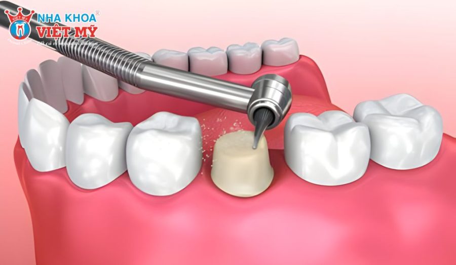 Quy trình bọc răng sứ 1 chiếc