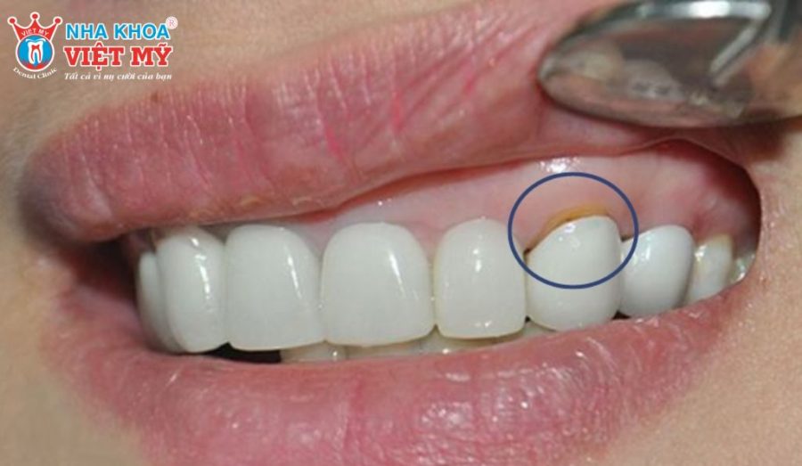 Hạn chế của việc bọc răng sứ 1 chiếc