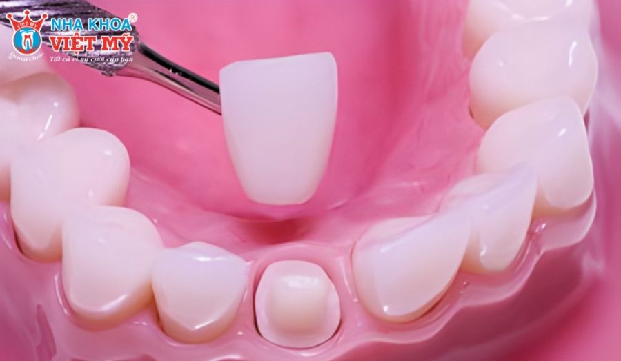 Trường hợp nào nên bọc răng sứ 1 chiếc