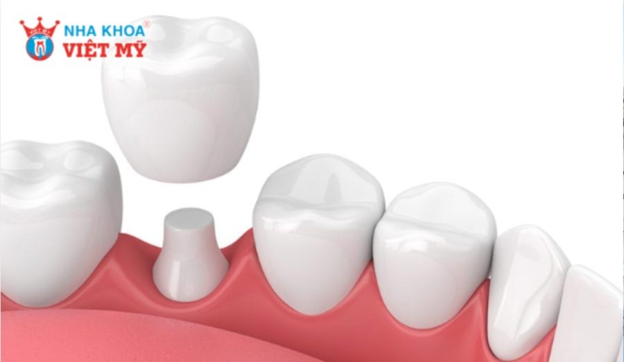 Bọc răng sứ 1 chiếc được không?