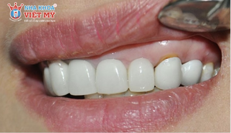 Bọc răng sứ bị hỏng do đâu?