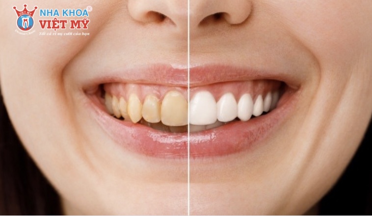 Bọc răng sứ bị hỏng có làm lại được không?