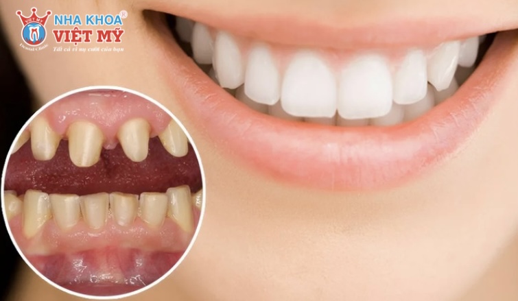 Bọc răng sứ bị hỏng có nguy hiểm không?