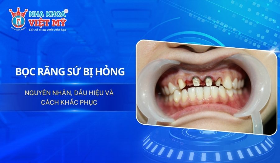 Bọc răng sứ bị hỏng: Nguyên nhân, dấu hiệu và cách khắc phục