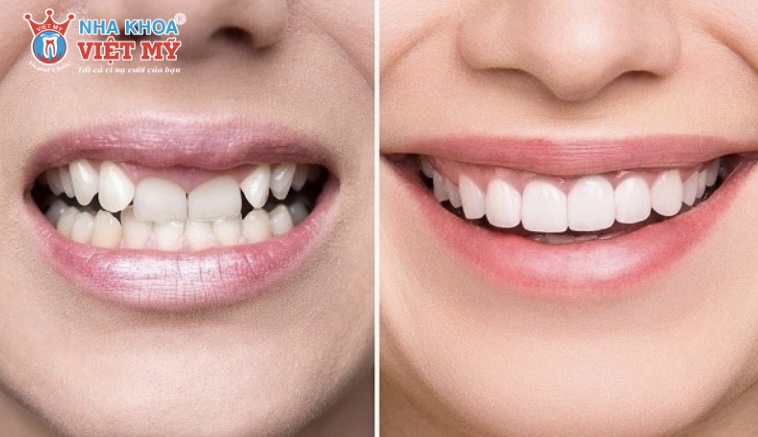 Cách phòng tránh bọc răng sứ bị hỏng