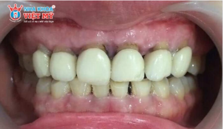 Tình trạng bọc răng sứ bị hỏng là?