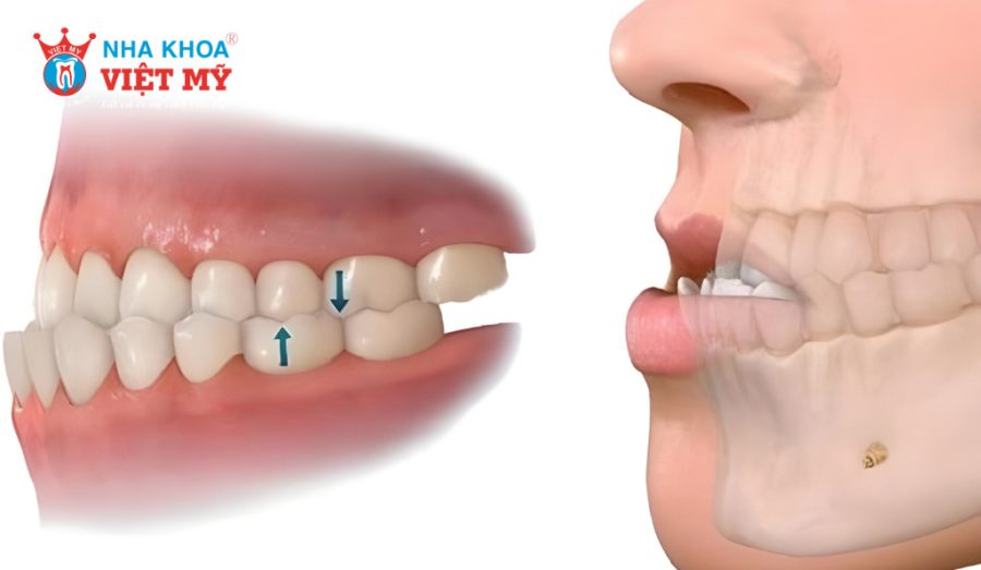Nguyên nhân gây ra tình trạng răng móm
