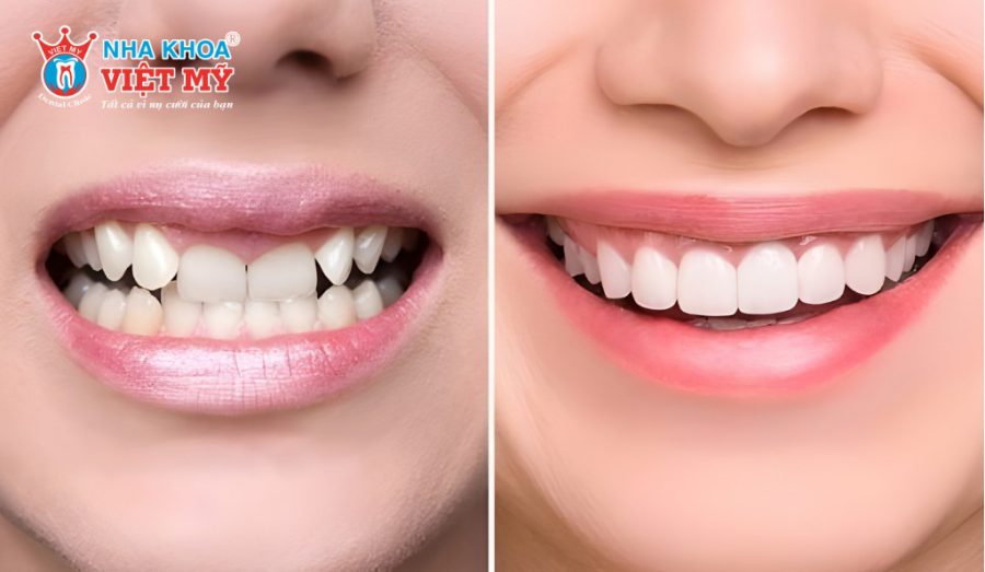 Bọc răng sứ có hết móm không là câu hỏi nhiều người thắc mắc