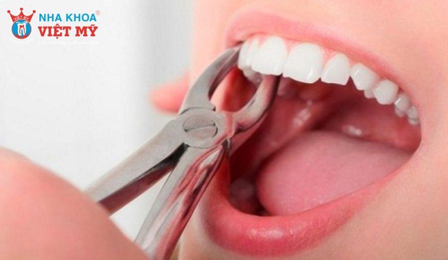 Bọc răng sứ có phải có nhổ răng không?