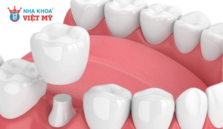 Bọc răng sứ trả góp ở TPHCM giúp bạn không còn lo về tài chính