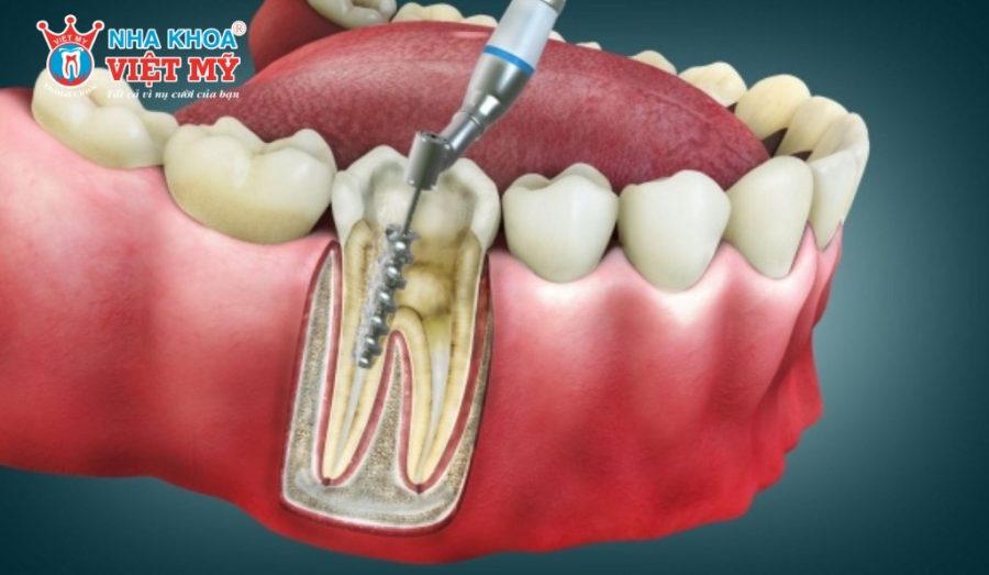 Bọc răng sứ xong nhai bị đau do viêm tủy