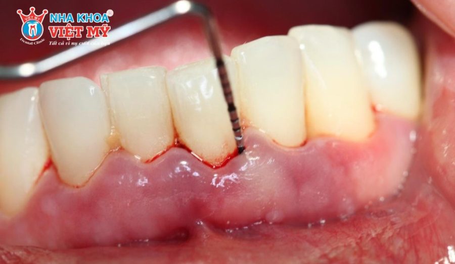 Có nên tháo răng sứ khi bị đau không?