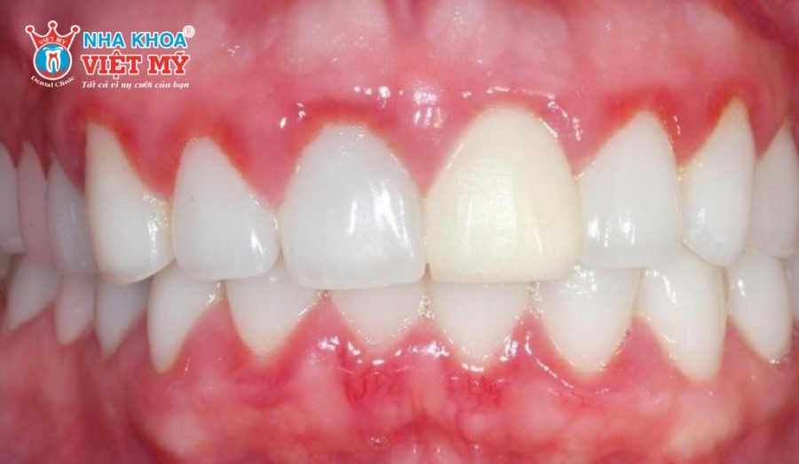 Bọc răng sứ xong nhai bị đau tăng nguy cơ viêm nướu