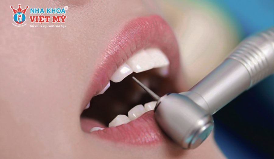 Tuân thủ đúng quy trình bọc răng sứ để tránh bị đau