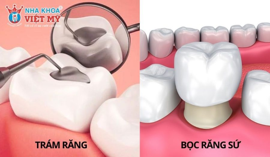 Cách chữa hỏng men răng tại nha khoa