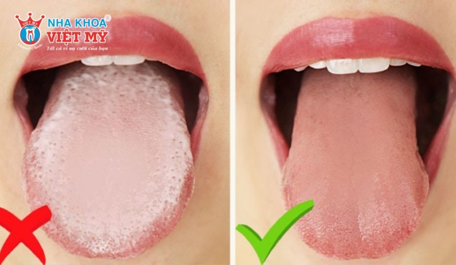 Tầm quan trọng của việc làm sạch lưỡi